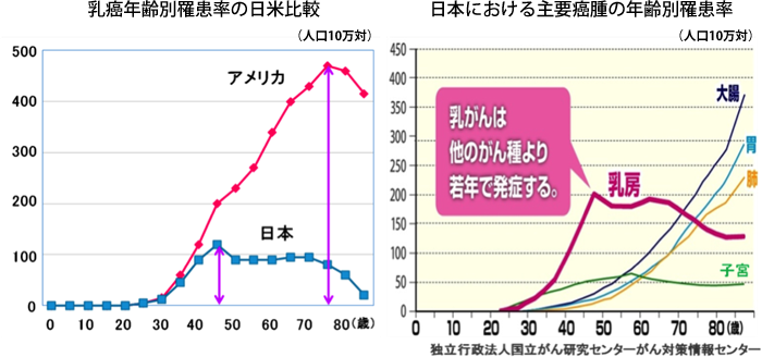 乳癌年齢別罹患率の日米比較と日本における主要癌腫の年齢別罹患率